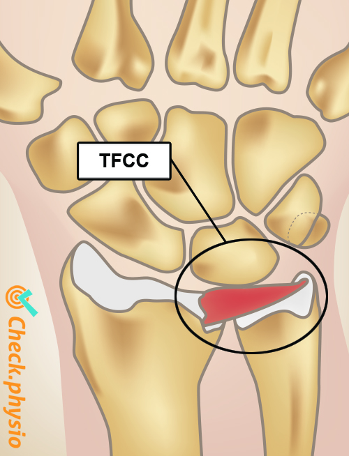 Handgelenk TFCC