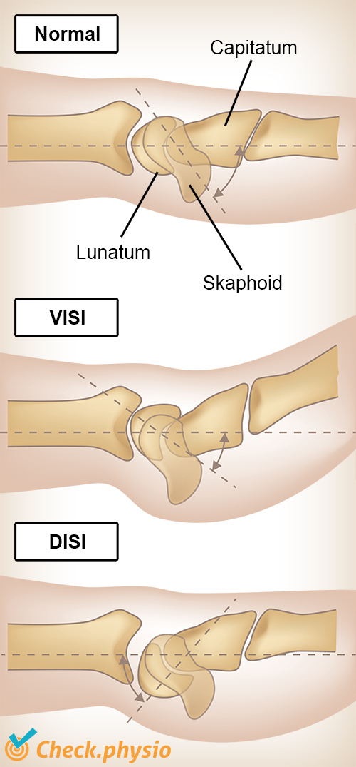 afbeelding_alt_pols-VISI-DISI