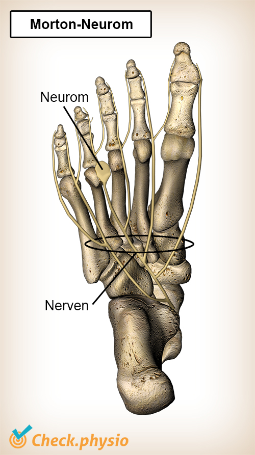 Fuß Morton Neurom