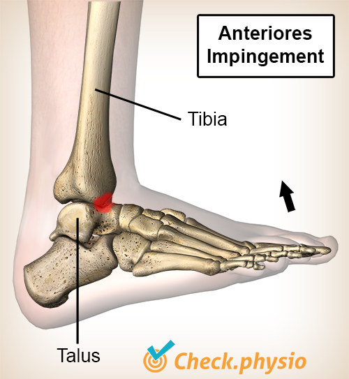 Sprunggelenk anteriore Einklemmung Dorsalflexion