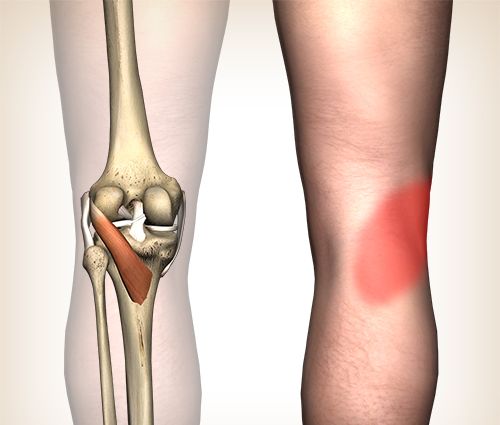Online Übungsprogramm Patellaspitzensyndrom / Jumpers Knee